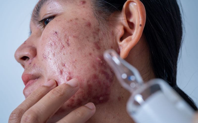 Acne and Acne Scars Acne and Acne Scars