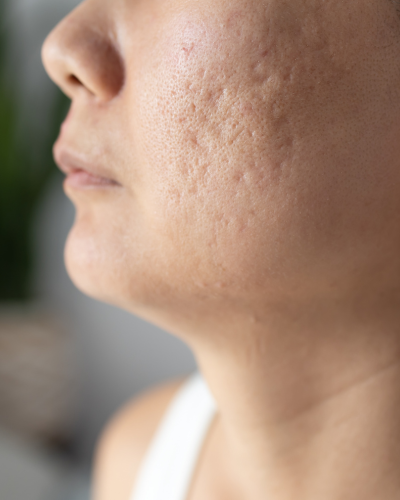 Acne and Acne Scars Acne and Acne Scars<br />