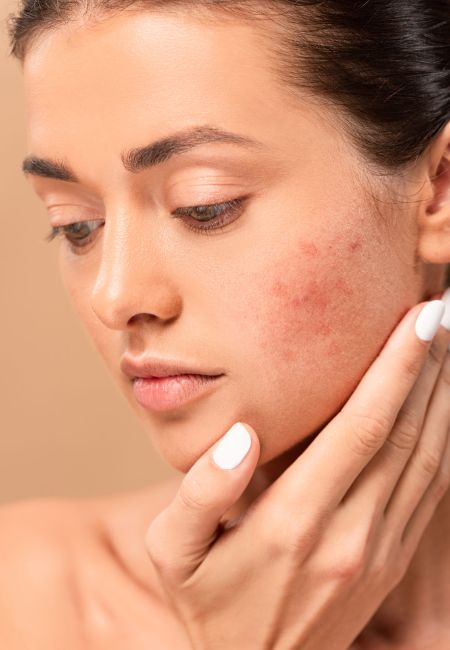 Acne and Acne Scars Acne and Acne Scars