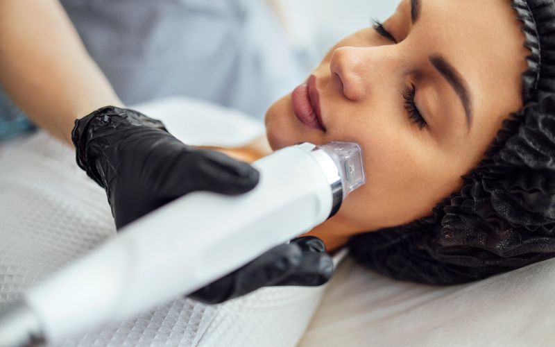 Microneedling Microneedling