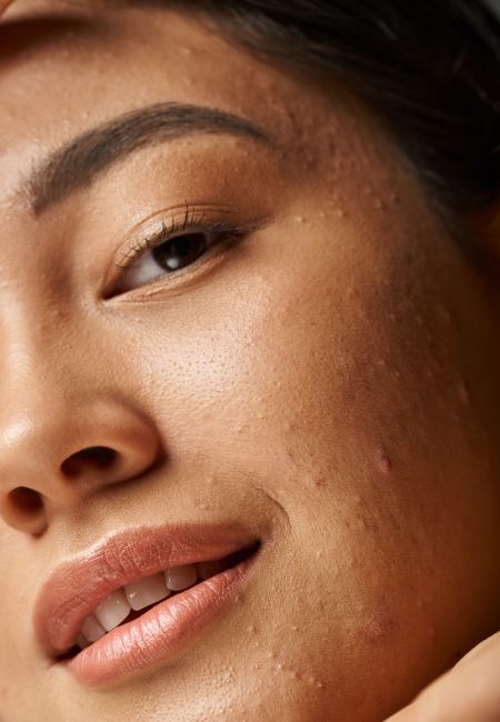 Microneedling Microneedling