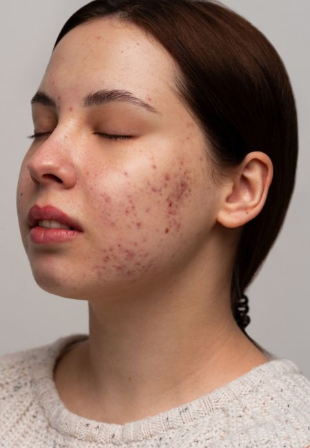 Pigmentation Pigmentation