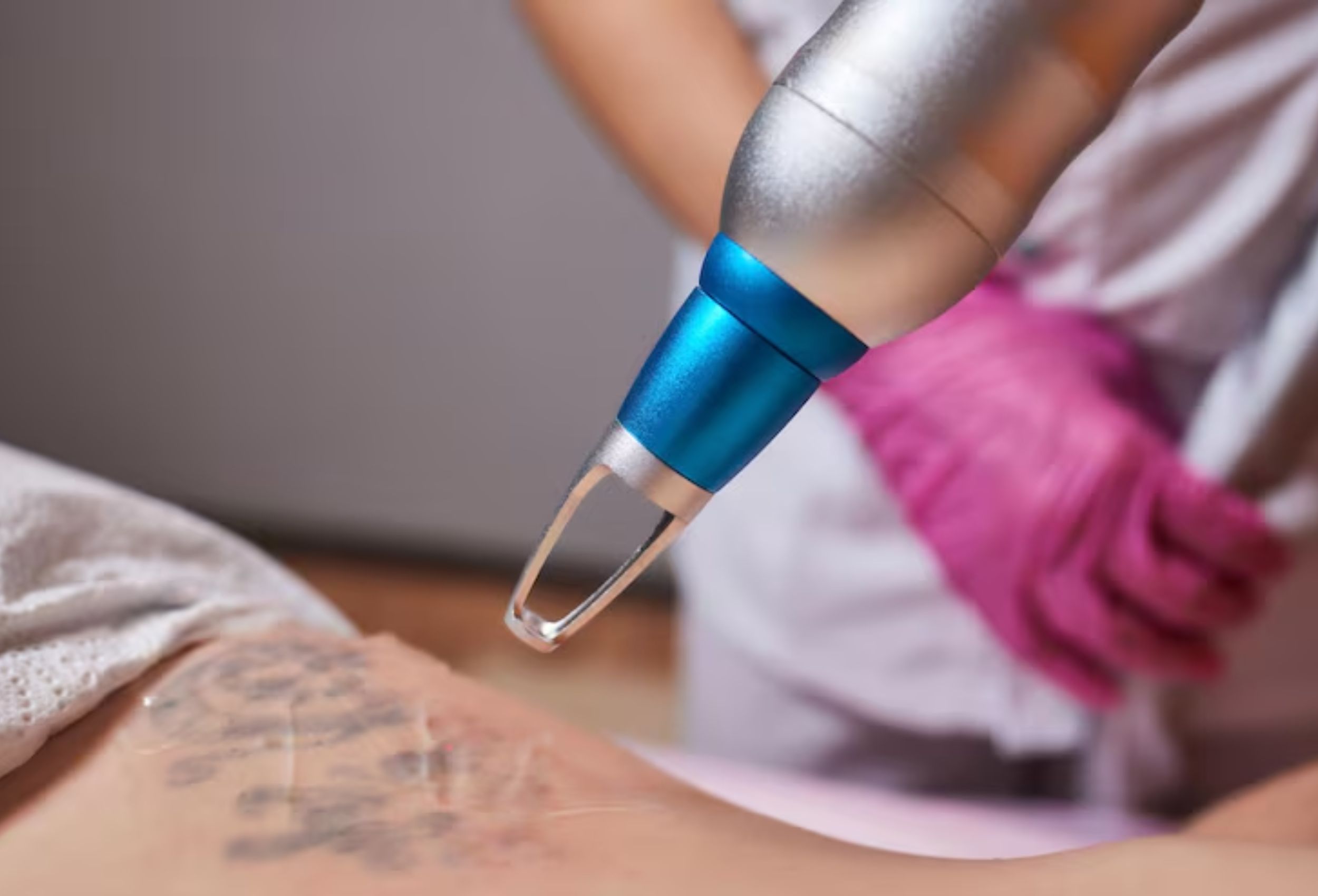 Tattoo Removal Treatment Tattoo Removal Treatment