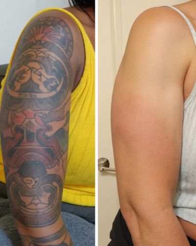Tattoo Removal Treatment Tattoo Removal Treatment